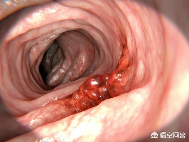今日科普一下！腹泻几天确诊结肠癌,百科词条爱好_2024最新更新