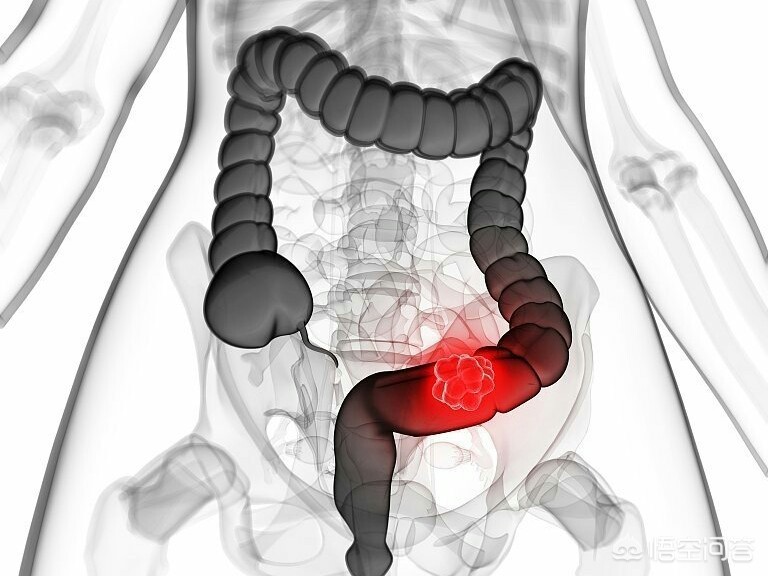 今日科普一下！腹泻几天确诊结肠癌,百科词条爱好_2024最新更新