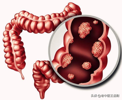 今日科普一下！腹泻几天确诊结肠癌,百科词条爱好_2024最新更新